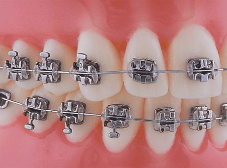 Брекеты Synergy крючок на клыке/премоляре kit SWLF .018 (RMO)